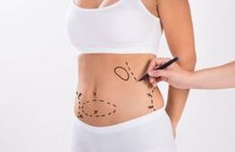 Liposuction