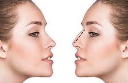 Rhinoplasty